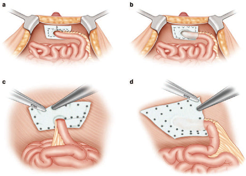 ¿¿ qué debo hacer con el prolapso de la enteroplastia? 